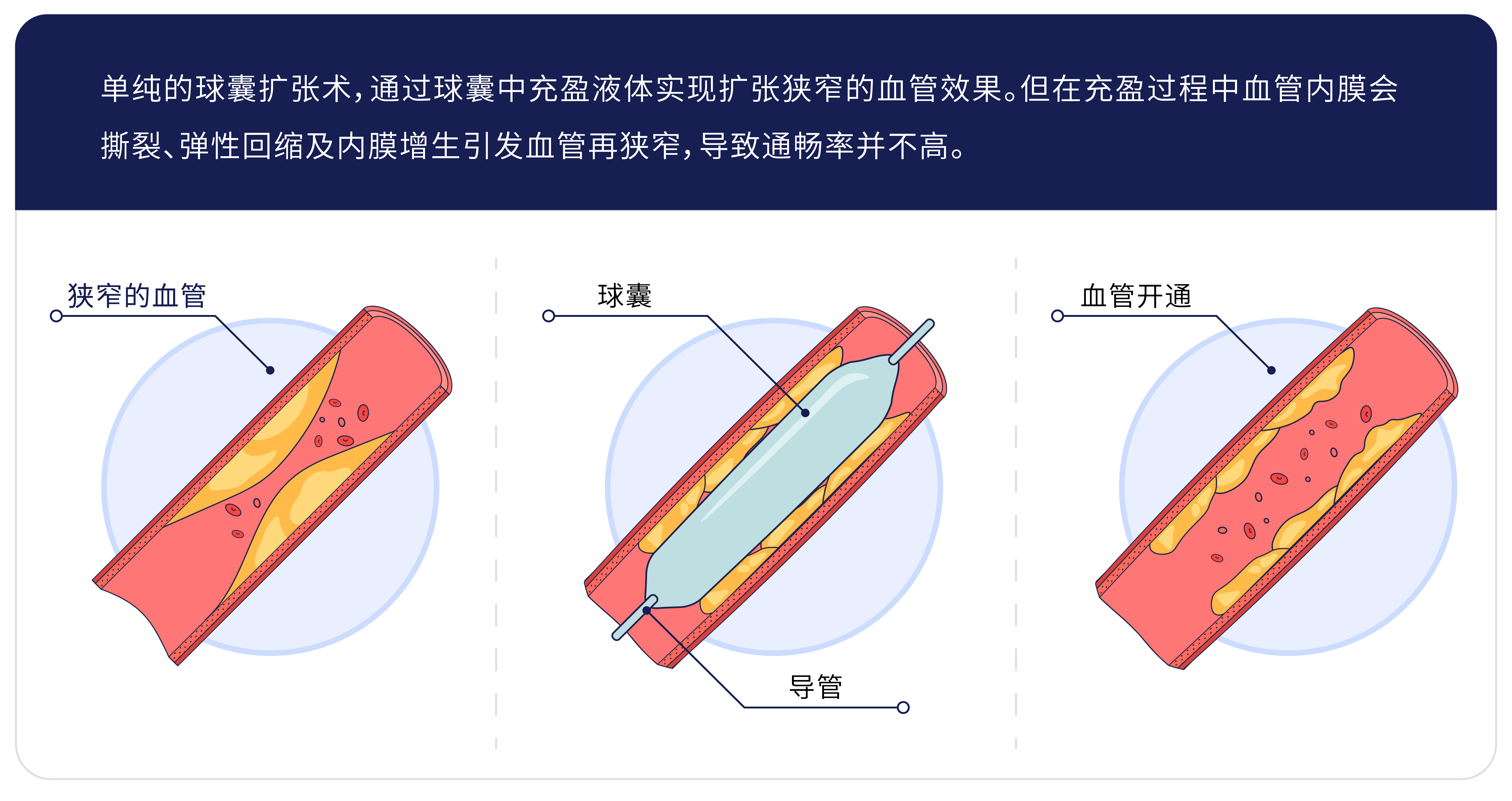 球囊擴張術(shù).jpg