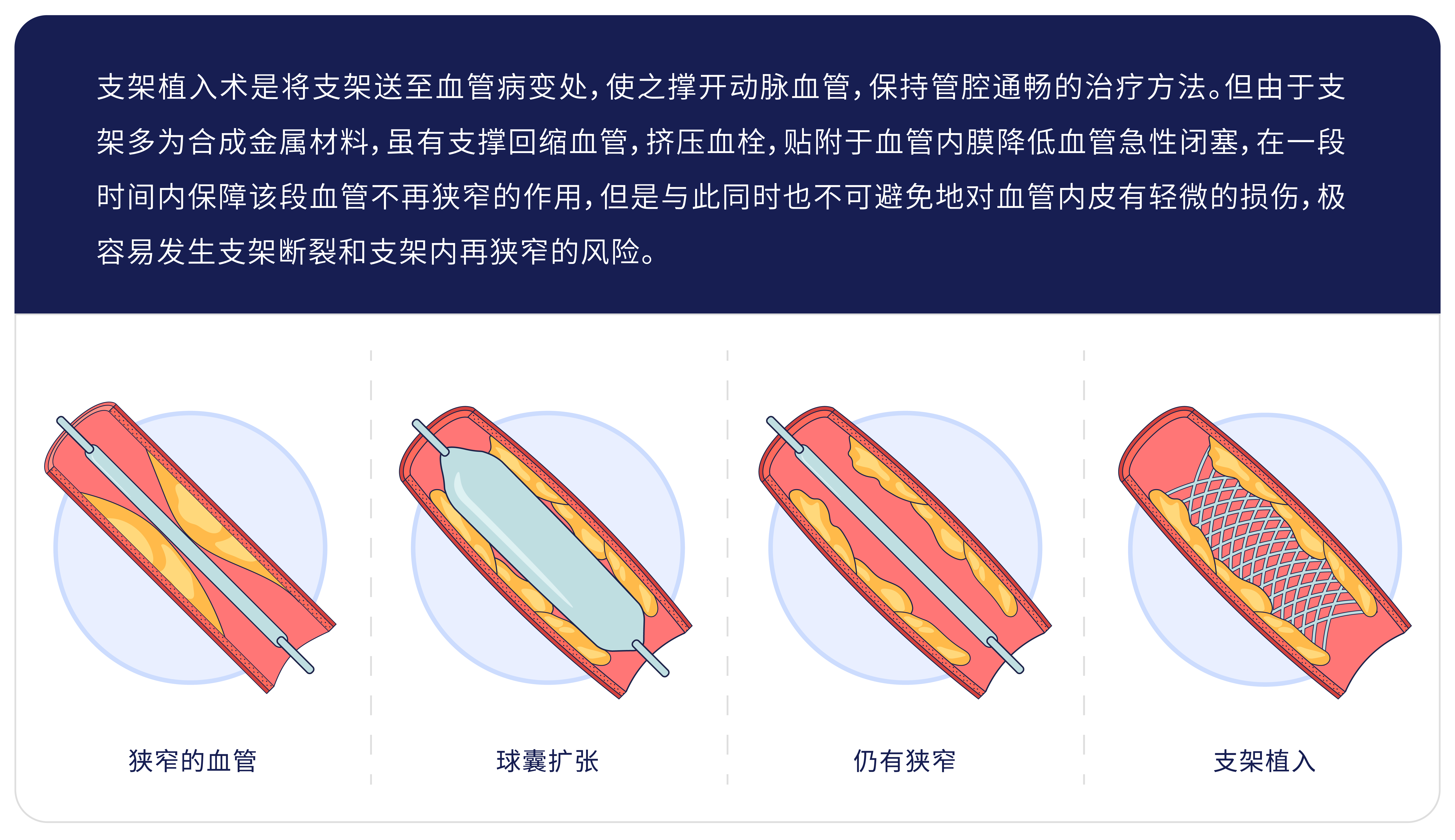 支架植入術(shù).jpg